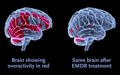 استفاده از روش حساسیت زدایی با حرکات سریع چشم و باز پردازش مجدد (EMDR) در بهبود ناهنجاری هایی مانند اضطراب، استرس پس از سانحه و پانیک