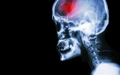 مدیریت اختلالات شناختی پس از آسیب مغزی