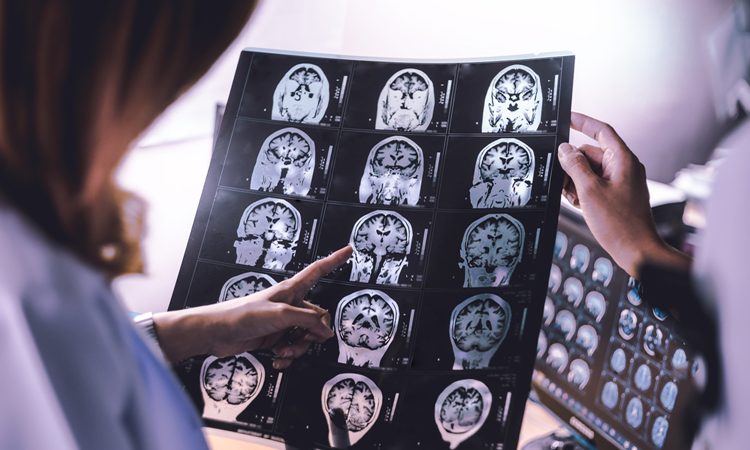 چگونگی گسترش آتروفی مغز در بیماران مبتلا به زوال عقل