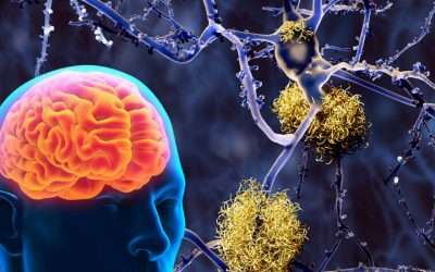 با تشخیص التهاب در مراحل اولیه آلزایمر می توان از پیشروی آن جلوگیری کرد
