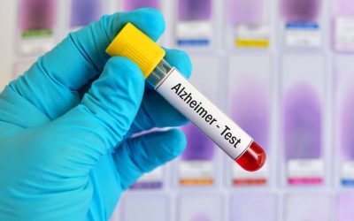 تشخیص آلزایمر توسط آزمایش خون