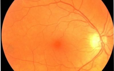 یادگیری ماشین به کمک پزشکی می آید: تشخیص زودهنگام پارکینسون با یک تصویر ساده ی چشمی
