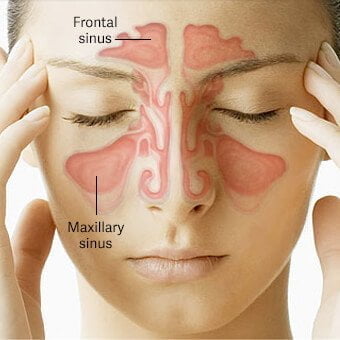 ۷ درمان خانگی برای سردرد سینوسی