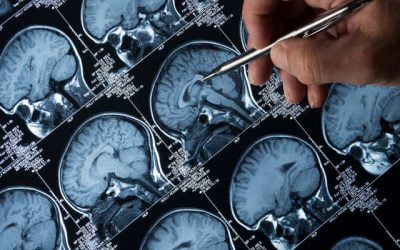 آزمایشات پزشکی برای تشخیص آلزایمر