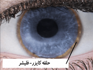 بیماری ویلسون: بیماری ژنتیکی با تجمع مس در بدن | سلامت مغز | A.S.Jafari | 1