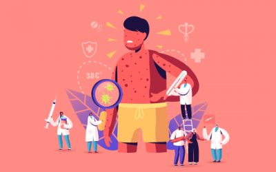 آیا استرس می تواند باعث زونا شود؟