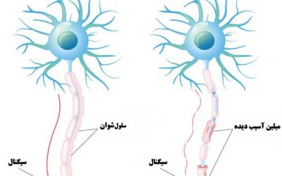 آشنایی با علائم ام اس یا مولتیپل اسکلروزیس (MS)