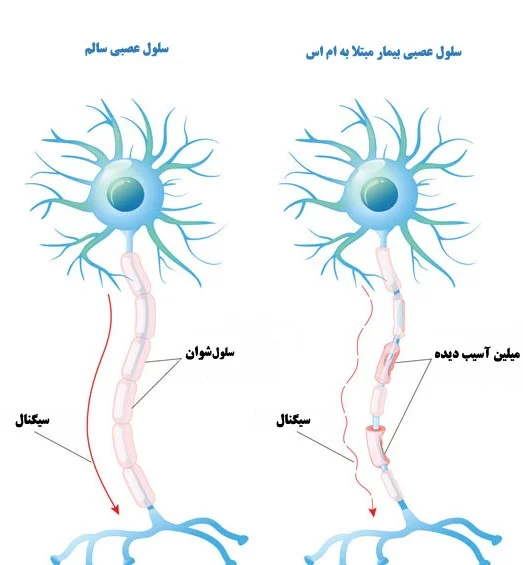 بیماری خود ایمنی و ام اس