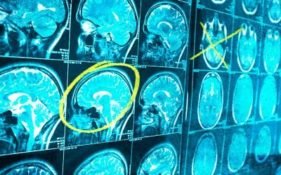 تومورهای مغزی! علائم هشدار دهنده را بشناسیم
