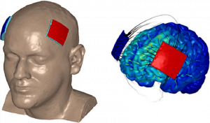 بهبود حافظه با کمک تحریک الکتریکی مغزی یا tDCS در شیراز | سلامت مغز | Dr.Kh.Rahimi Jaberi | 3