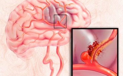 آیا آنوریسم مغزی ارثی است؟