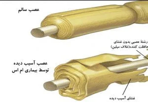 بیماری خود ایمنی و ام اس