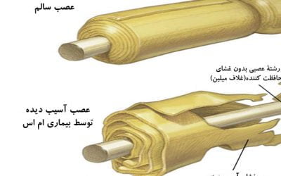 آسیب سلول های عصبی در ام اس