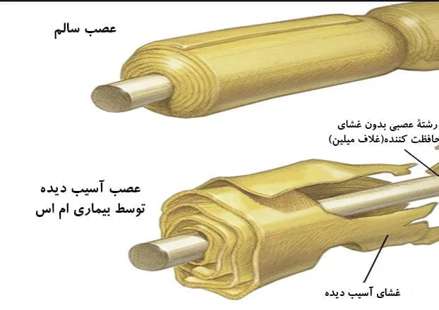 آسیب سلول های عصبی در ام اس
