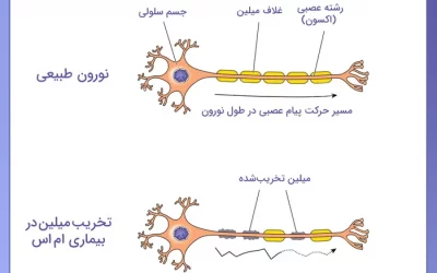 دمیلیناسیون یا تخریب میلین سلولهای عصبی