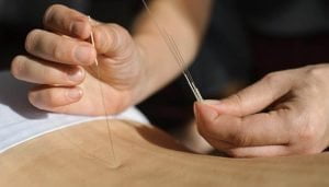 طب سوزنی و ام اس