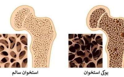 پوکی استخوان: علل، تشخیص و درمان