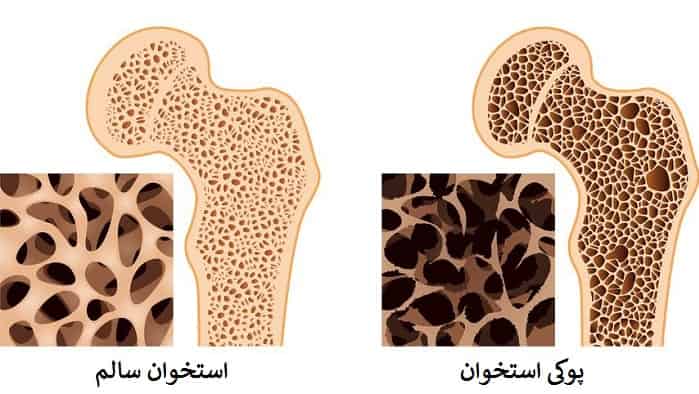 پوکی استخوان: علل، تشخیص و درمان