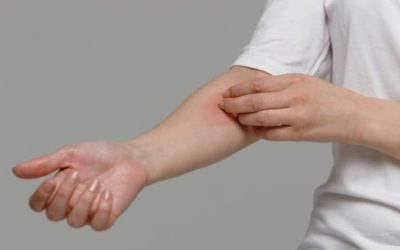 خارش در ام اس