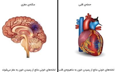 سکته مغزی و حمله قلبی : چگونه آنها را ازهم تفکیک کنیم؟