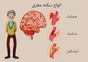 علائم سکته مغزی در زنان | سلامت مغز | A.S.Jafari | 1