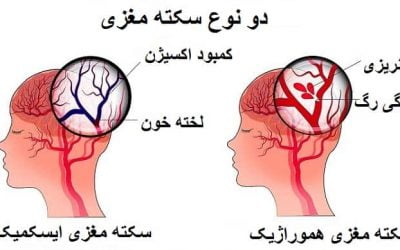 علائم و نشانه های سکته کوچک (TIA)