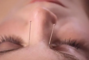 طب سوزنی چیه و دقیقا چطوری در تسکین درد کار می کنه؟ | سلامت روان | Dr.Kh.Rahimi Jaberi | 3