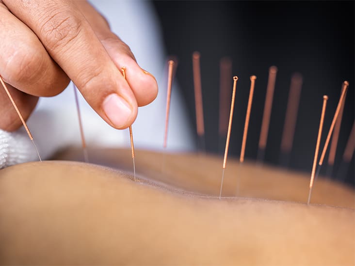 طب سوزنی چیه و دقیقا چطوری در تسکین درد کار می کنه؟