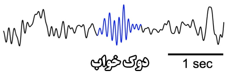 احساس بیداری در خواب 1 دوک های خواب، امواج مغزی خاصی هستند که در طول خواب مخصوصا مرحله 2 خواب بوجود می آیند