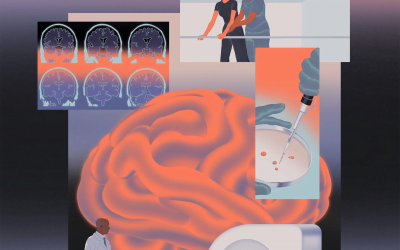 تشخیص زودهنگام ام اس: درمان MS در مراحل اولیه و کند کردن پیشرفت بیماری