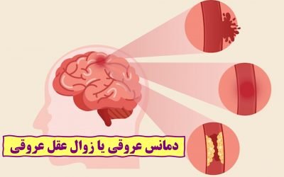 دمانس عروقی یا زوال عقل عروقی