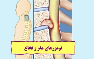 انواع تومورهای مغز و نخاع در بزرگسالان