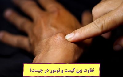 تفاوت بین کیست و تومور در چیست؟