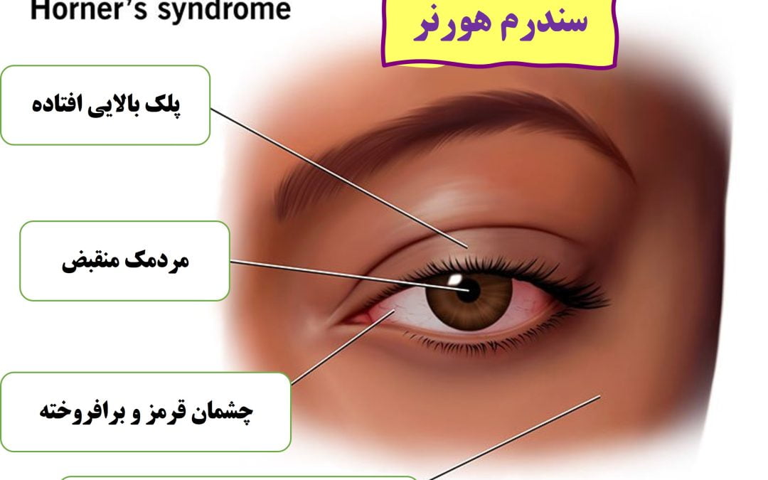 سندرم هورنر چیست؟