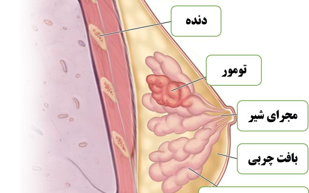 سرطان پستان