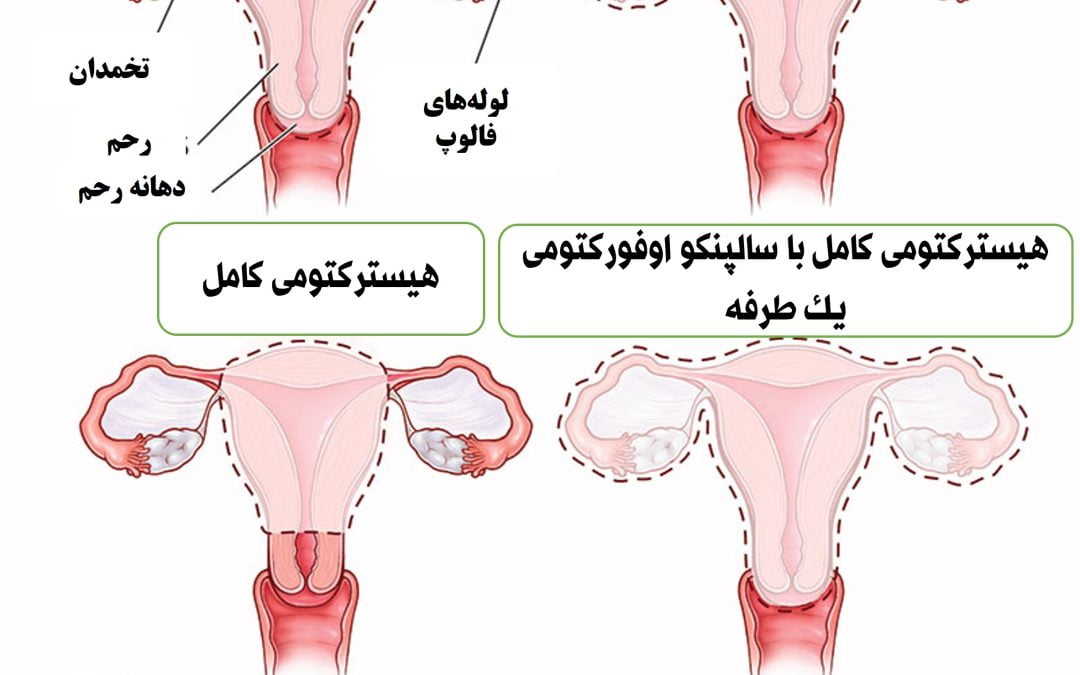 هیسترکتومی یا خارج کردن رحم