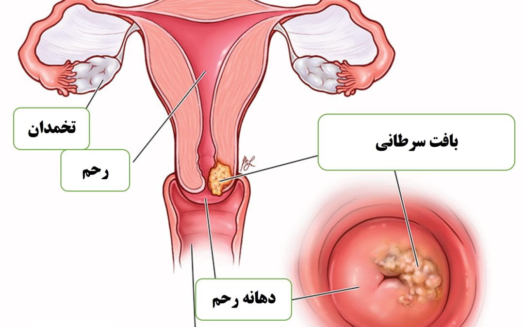 سرطان دهانه ی رحم