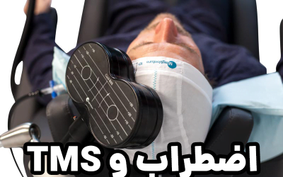 درمان اضطراب با تحریک مغناطیسی فراجمجمه‌ای (TMS)