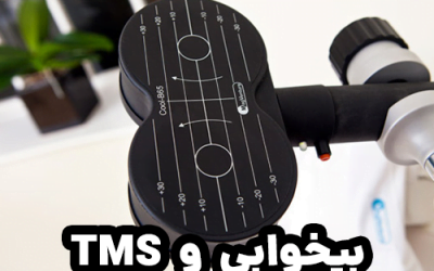 درمان بی خوابی با تحریک مغناطیسی مغز (TMS)
