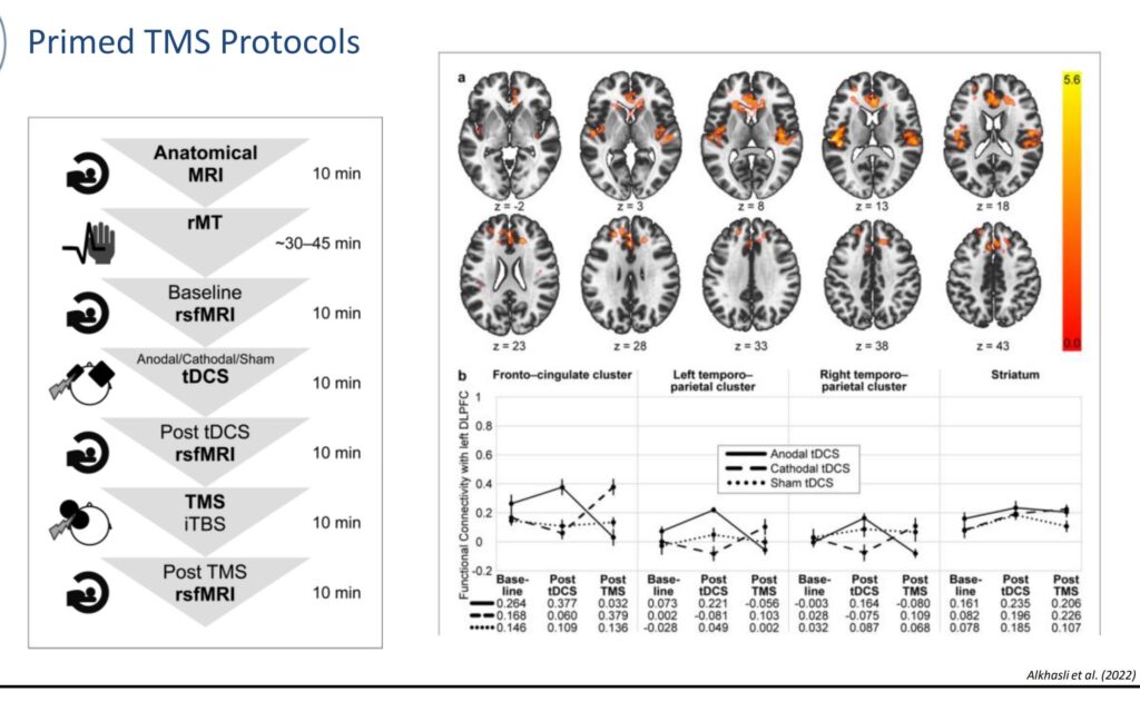 پرایمینگ TMS با tDCS: چگونه «آمادهسازی مغز» پاسخ iTBS را قویتر میکند؟ 1 پرایمینگ TMS