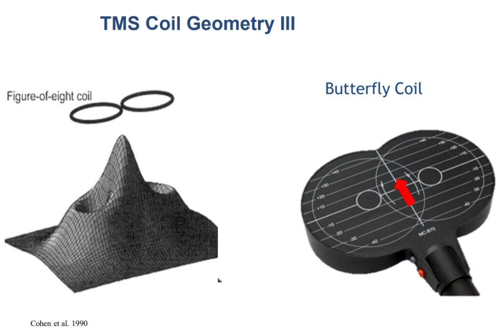 راهنمای کامل درمان با تحریک مغناطیسی مغز TMS/rTMS 7 هندسه کویل پروانه ای